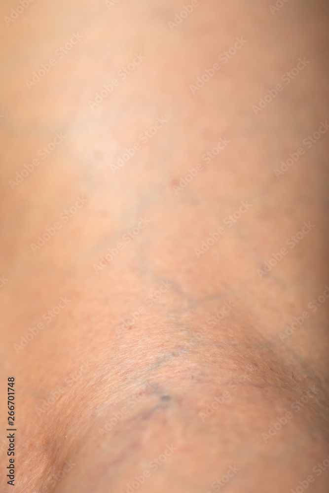 Fototapeta premium Spider veins on human leg