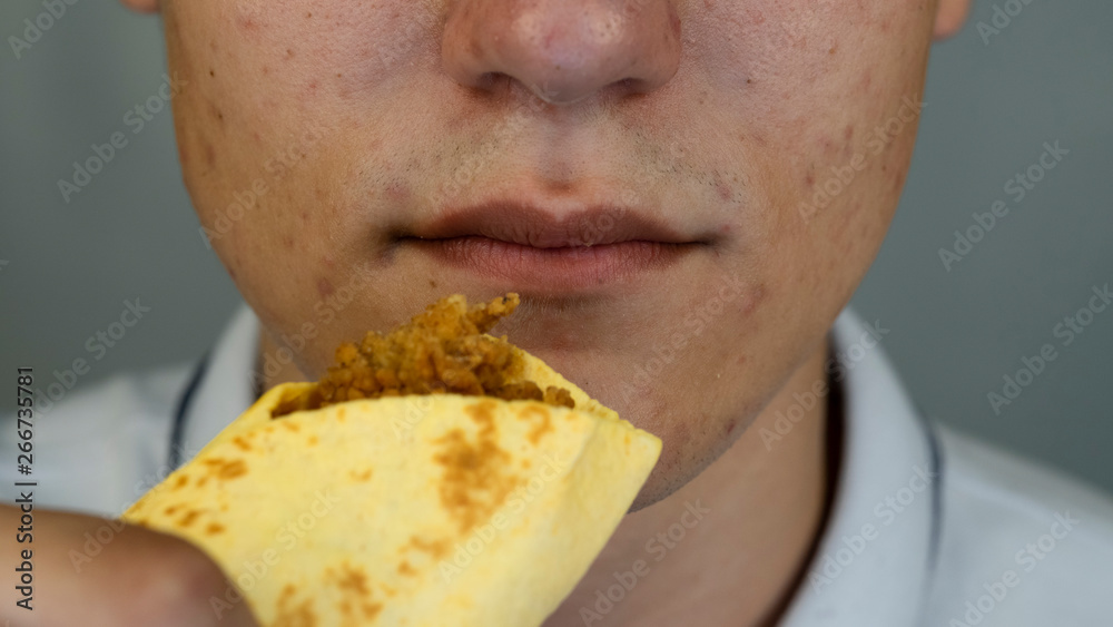 Teenager with pimples and acne on face is eating junk food, close up Teenager with pimples and acne on face is eating junk food, close up