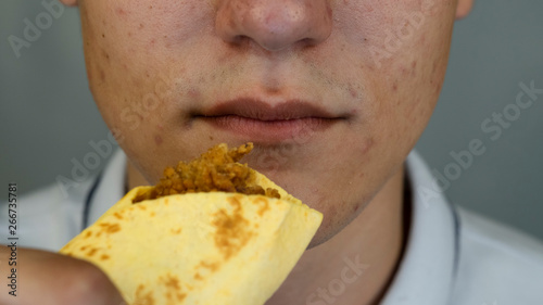 Teenager with pimples and acne on face is eating junk food, close up