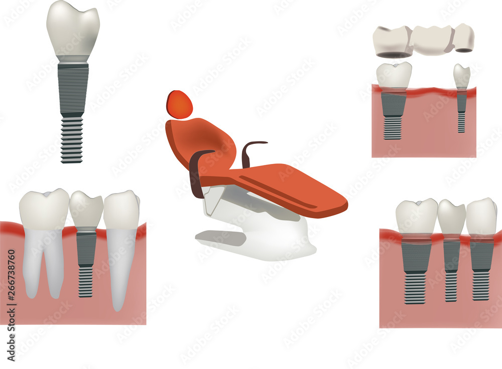 protesi dentale impianto studio dentistico