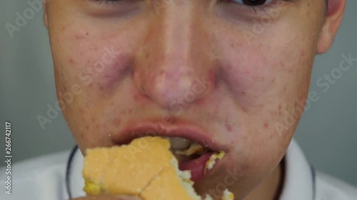 Happy face of a teenager, with pimples and acne on the face, who eats a hamburger and smiling closeup