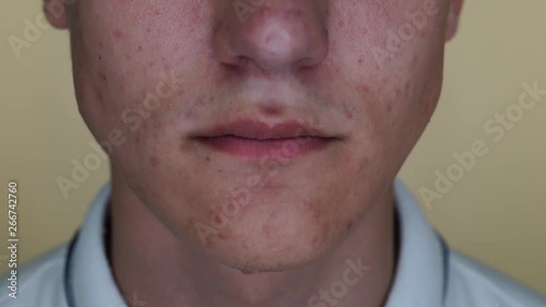 Teen with pimples and acne on the face is eating fries, Close up. The concept of unhealthy food