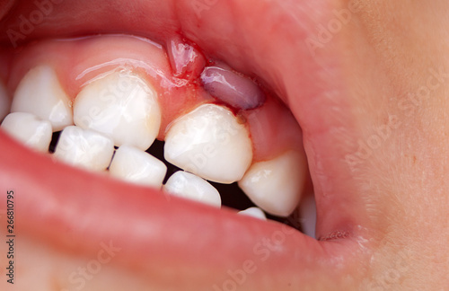 Zahnfleischverletzung