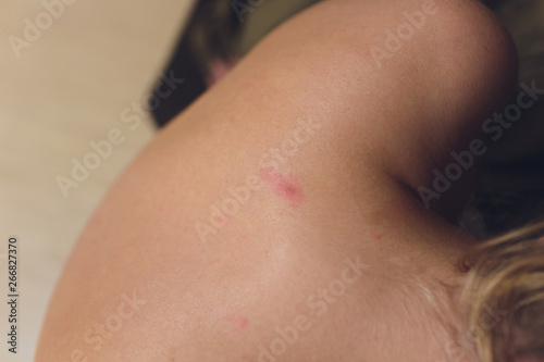 Health allergy skin care problem. Closeup young woman scratching her itchy back with allergy rash. photo