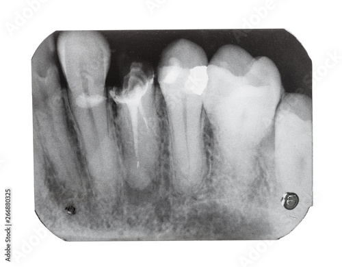 film with X-ray image of teeth with dental pin photo