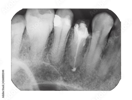 X-ray image of human teeth with dental pin photo