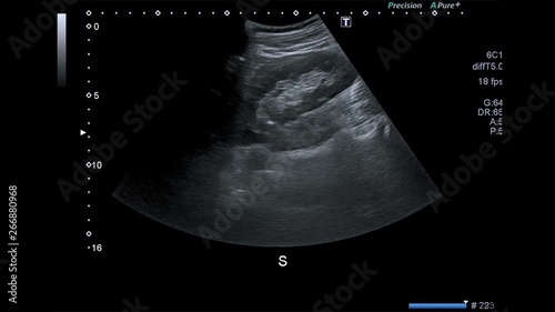Lymph nodes ultrasound abdomen of healthy adult human male