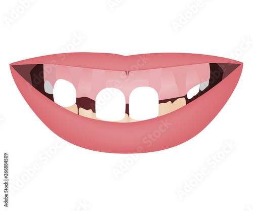 Kids jaws with gummy smile, crooked lower teeth and distal bite before the orthotropics or orthotropics treatment. Vector illustration
