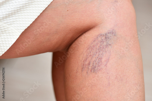 Photography Varicose veins on female legs in the area of the knee and calves