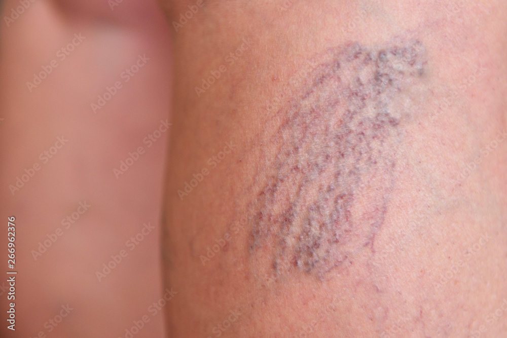 Varicose veins on female legs in the area of the knee and calves. Sipder veins thigh, close-up