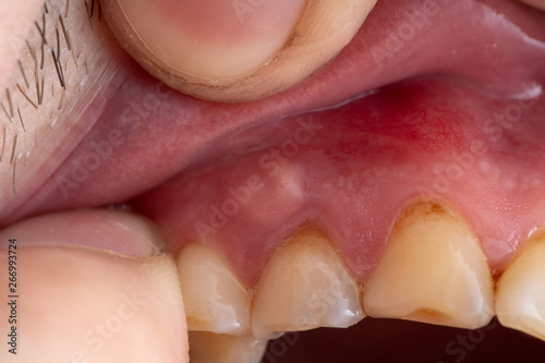 Foto inflammation of the gums abscess closeup, teeth in poor condition with caries