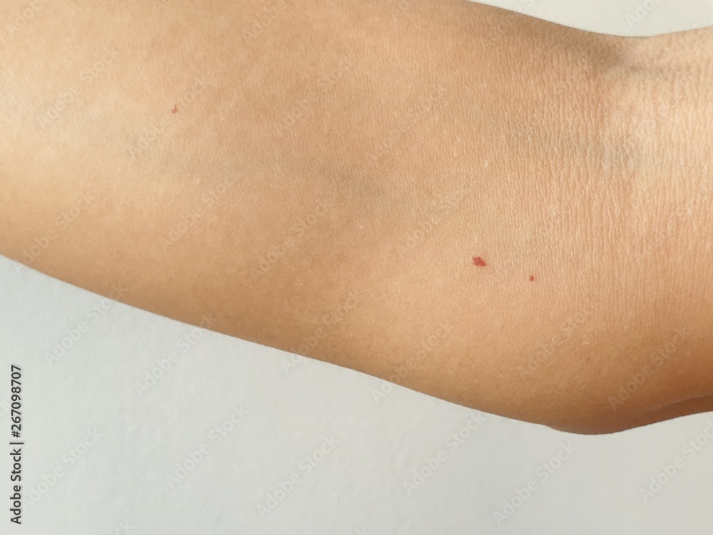 Cherry angiomas on arm skin, Red dot suddenly appeared. Stock Photo