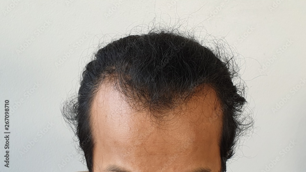 Closeup the front of head lose hair of asian man. Glabrous as V shape. Stock Photo | Adobe Stock Closeup the front of head lose hair of asian man. Glabrous as V shape. Stock Photo | Adobe Stock