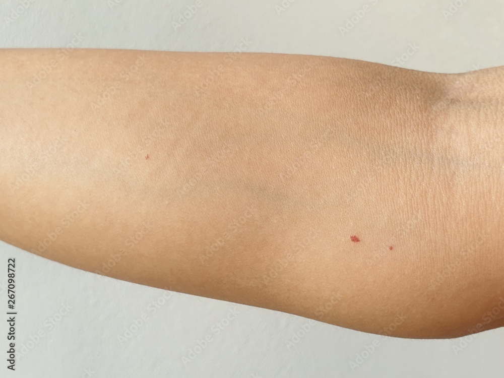 Cherry angiomas on arm skin, Red dot suddenly appeared. foto de Stock