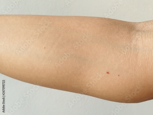 Quadro su tela Cherry angiomas on arm skin, Red dot suddenly appeared.