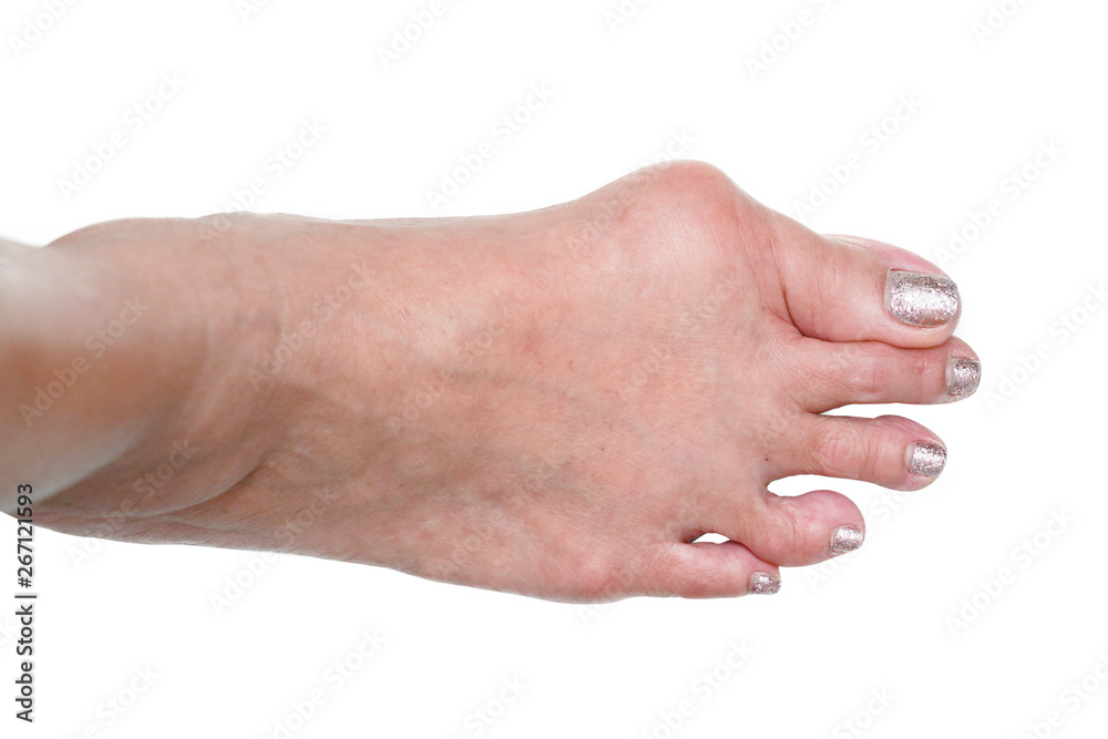 isolated background of foot deformity called bunion deformity or hallux valgus - obrazy, fototapety, plakaty 
