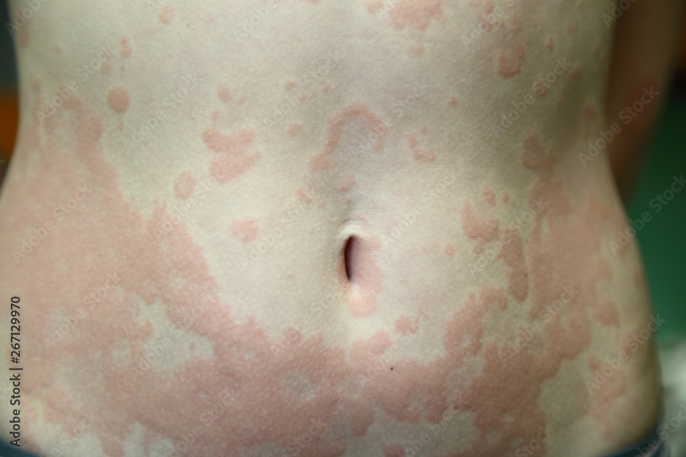 allergic dermatitis - obrazy, fototapety, plakaty 