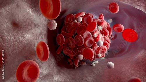 Depiction of a blood clot forming inside a blood vessel. 3D animation photo