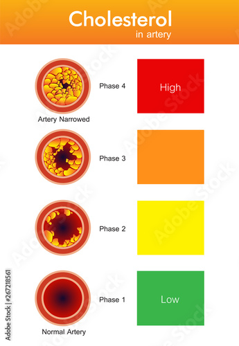 Cholesterol in artery, health risk , vector design