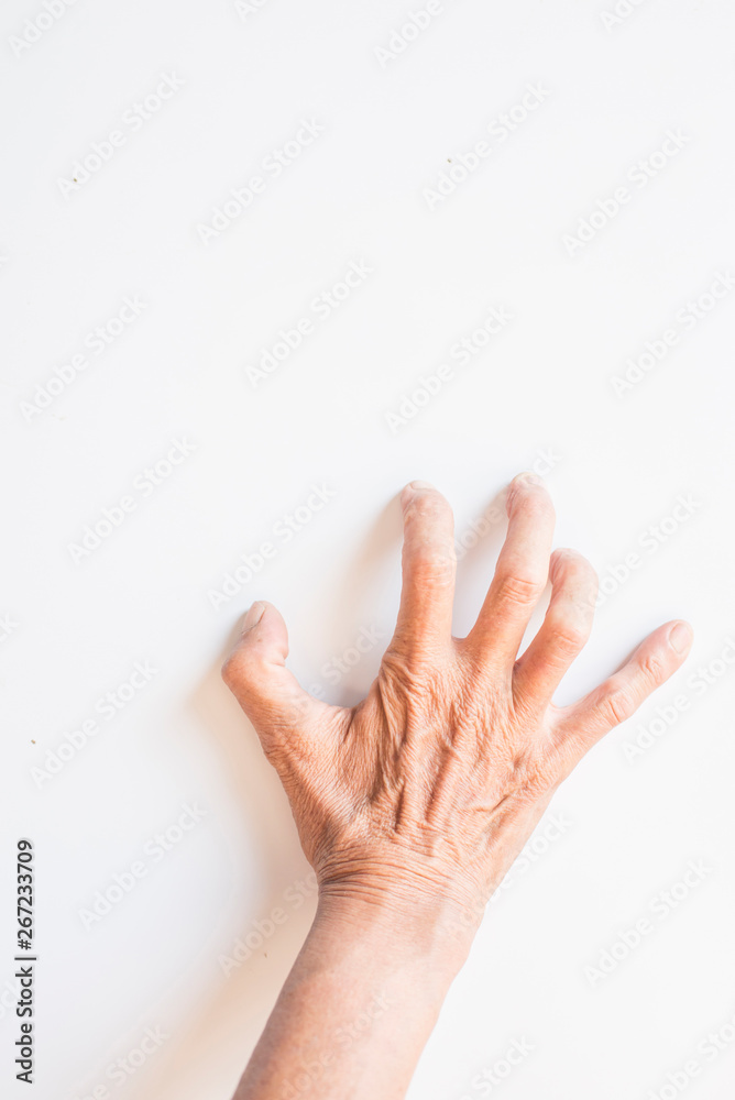 Trigger Finger a defect in a tendon causing a finger to jerk or snap straight when the hand is extended. Trigger Finger a defect in a tendon causing a finger to jerk or snap straight when the hand is extended.