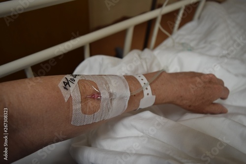 Drip. Intravenous intravenous injection. Intravenous injection route fixation