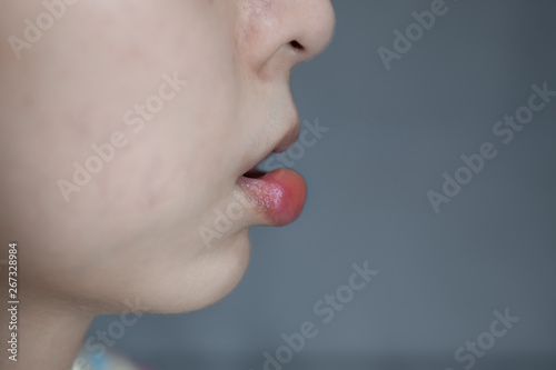 Closeup swollen lip of asian woman caused by insect bite, insect sting allergy, lip swollen.
