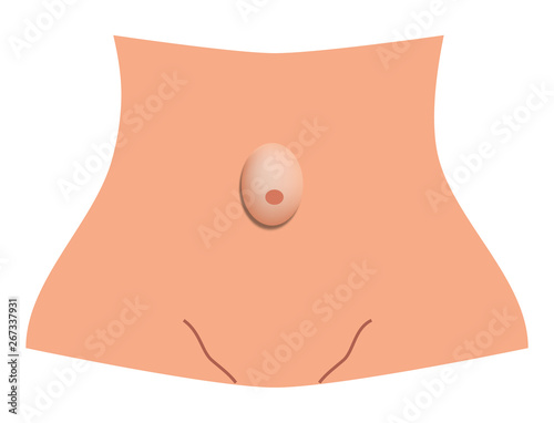 Umbilical hernia. intestinal hernia. Infographics. Vector illustration on isolated background.