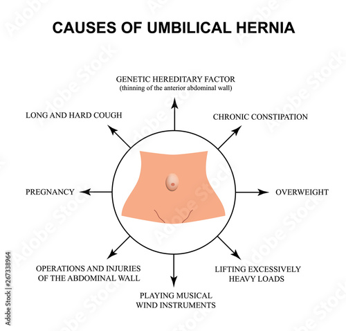 Causes of umbilical hernia. Infographics. Vector illustration on isolated background.