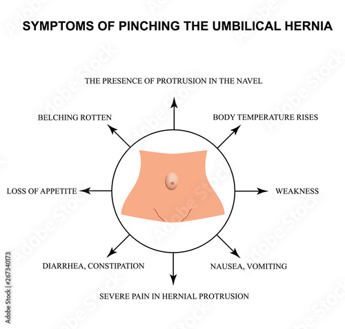 Symptoms of pinching the umbilical hernia. Infographics. Vector illustration on isolated background.