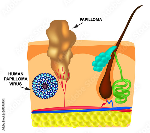 Human Papilloma Virus causes the formation of papillomas on the skin. Structure. Infographics. Vector illustration on isolated background.