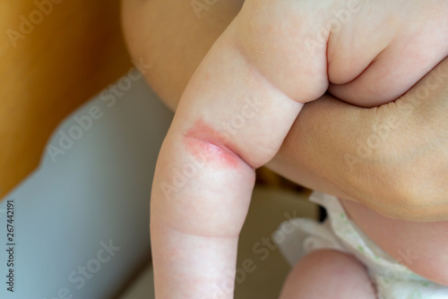 Prickly heat. Close-up of the folds of the hand of a newborn baby with red skin. 