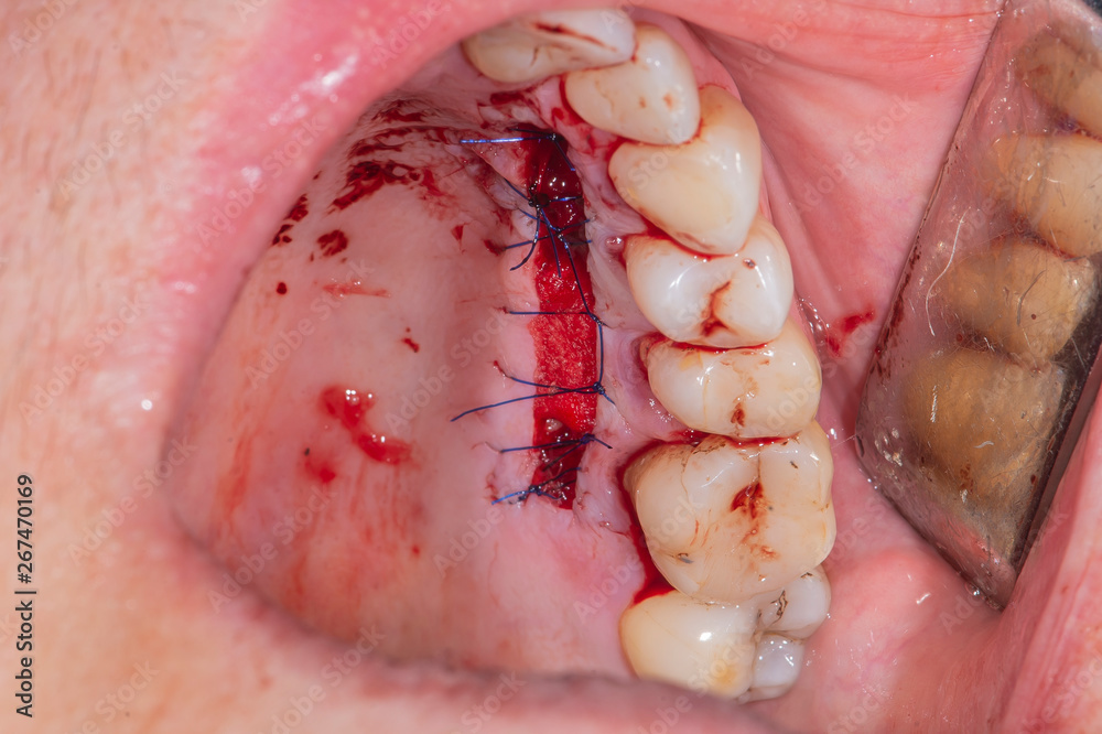 Obraz premium Real patient dental surgery