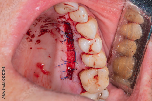 Foto Real patient dental surgery