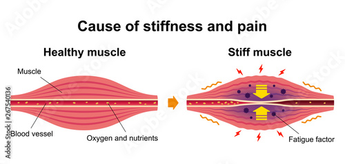 Cause of muscle's stiffness and pain illustration
