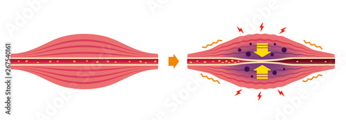Cause of muscle's stiffness and pain illustration (no text)