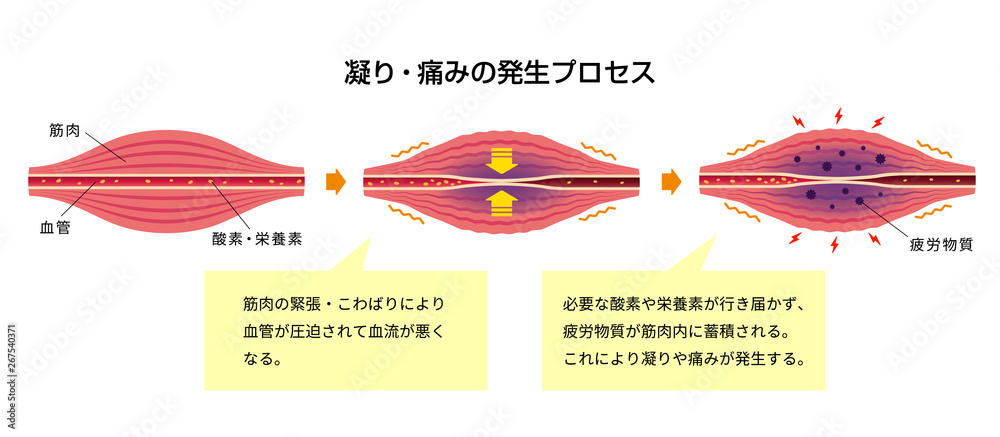 肩こり(凝り)・痛みの発生プロセス イラスト / 解説文付き Stock Vector | Adobe Stock