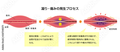 肩こり（凝り）・痛みの発生プロセス イラスト / 解説文付き