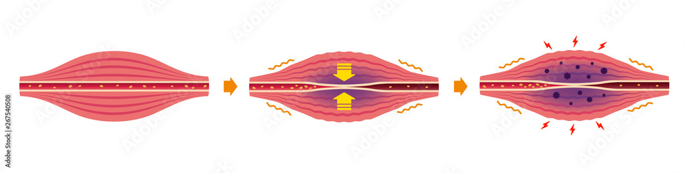 Cause of muscle's stiffness and pain illustration (no text) vector de ...