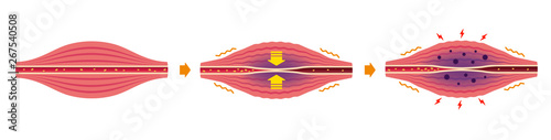 Cause of muscle's stiffness and pain illustration (no text)