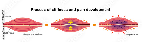 Cause of muscle's stiffness and pain illustration