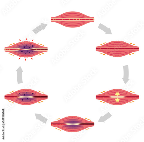 Process of muscle's stiffness and pain / circle type illustration (no text)