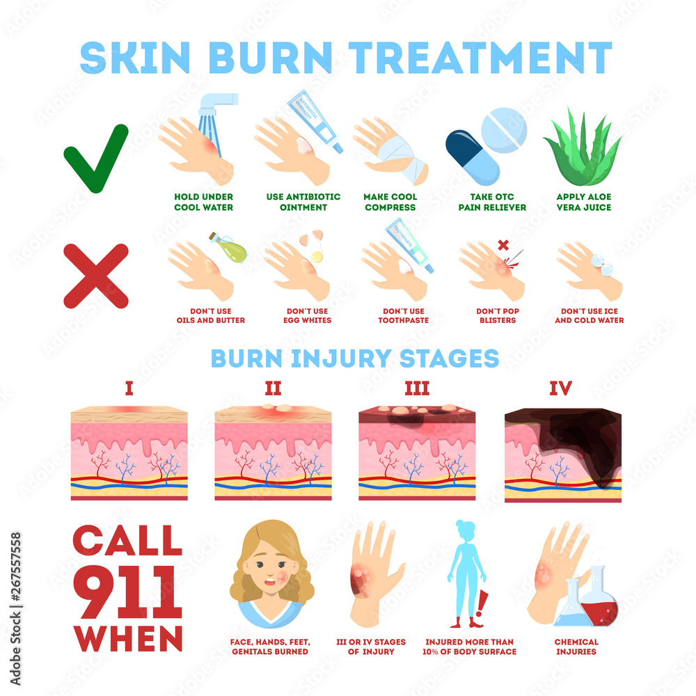 Skin burn injury treatment and stages infographic Stock Vector Adobe