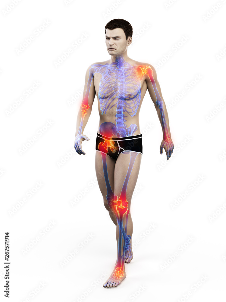 3d rendered medically accurate illustration of a walkers painful joints 3d rendered medically accurate illustration of a walkers painful joints