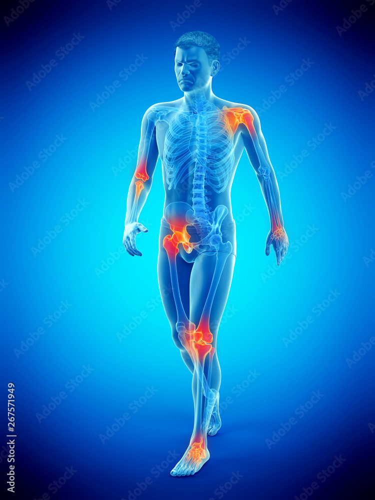 3d rendered medically accurate illustration of a walkers painful joints 3d rendered medically accurate illustration of a walkers painful joints