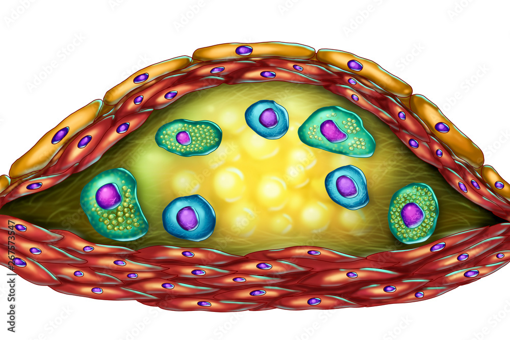 Structure of atherosclerotic plaque. Illustration showing necrotic
