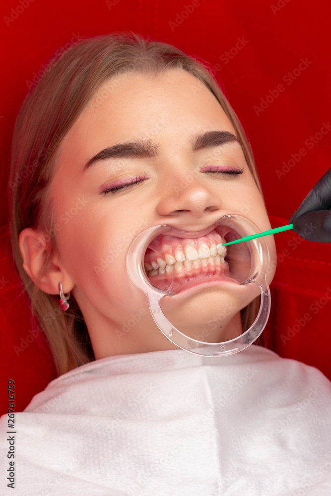 teeth whitening procedure the dentist puts a special tooth whitening product on the girl’s teeth teeth whitening procedure the dentist puts a special tooth whitening product on the girl’s teeth