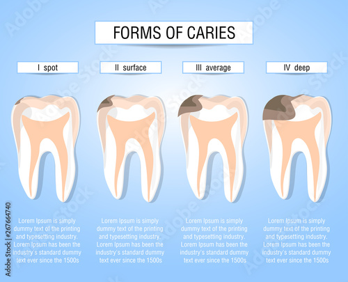 Forms of caries. Stages of development of carious process. Visual aid for students, dentists, patients of the clinic. Defeat is a source of destruction in the teeth. Vector illustration