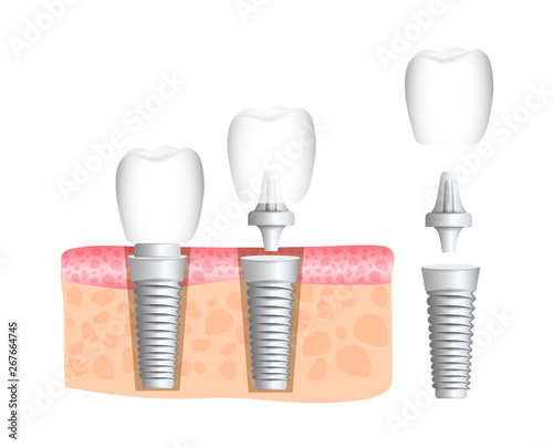 Realistic dental implant structure with all parts: crown, abutment, screw. Dentistry. Implantation of human teeth. Vector illustration