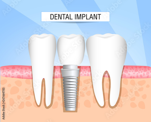 Realistic dental implant structure with all parts: crown, abutment, screw. Healthy teeth and dental implant. Dentistry. Implantation of human teeth. Vector illustration