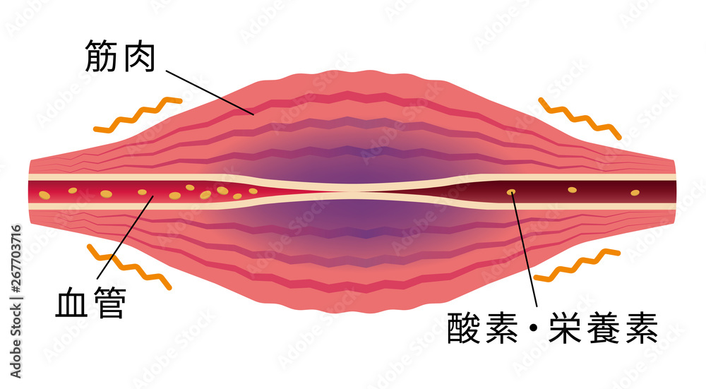 血流の悪化により酸素 栄養不足になった筋肉 肩こり 凝り 痛みの発生イラスト Stock Vector Adobe Stock 血流の悪化により酸素 栄養不足になった筋肉 肩こり 凝り 痛みの発生イラスト Stock Vector Adobe Stock